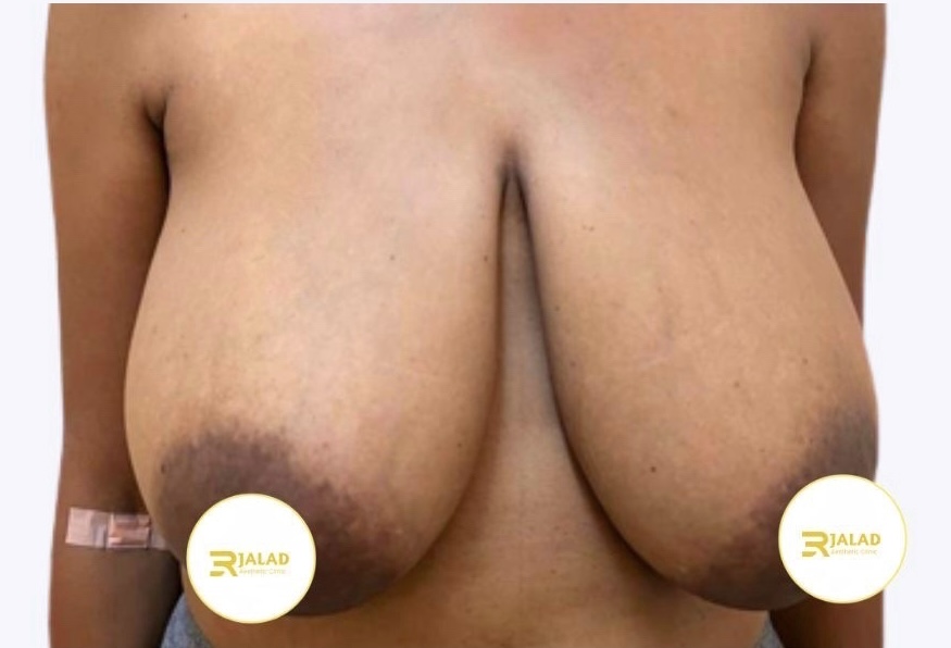 Breast reduction